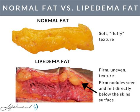 We work with medical insurance companies every day to get them to cover lymph sparing liposuction for our lipedema patients. . Does aetna cover lipedema surgery